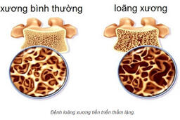 Những điều cân biêt về bệnh loãng xương, phòng bệnh và điều trị